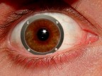 Riattaccamento della retina Riattaccamento della retina